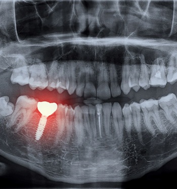 X-ray of dental implant failure in Jupiter
