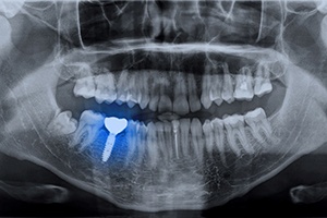 X-ray of dental implant after bone grafting in Jupiter