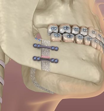 Illustration showing results of corrective jaw surgery