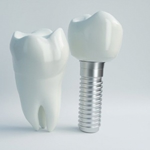 representation of dental implant