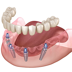Illustration of All-on-4 dental implants in Jupiter, FL