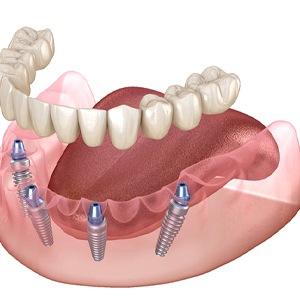All-on-4 Dentures