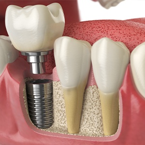 Animation of bone graft and dental implant process