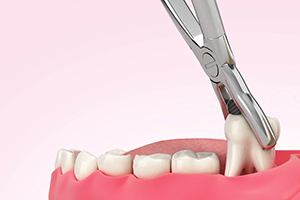 Diagram of a tooth extraction in Jupiter