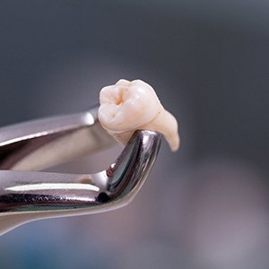 An extracted tooth in Jupiter