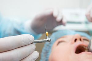 An up-close view of a dental implant that is to be inserted in a patient’s mouth in Palm Beach Gardens