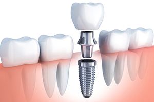 A digital image of a single tooth dental implant sitting along the lower arch between two healthy teeth in Palm Beach Gardens