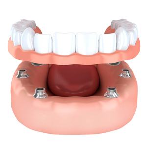 Implant dentures