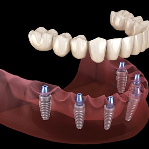 Implant dentures