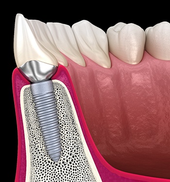 Diagram depicting before dental implant failure in Jupiter