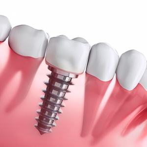 Diagram of dental implants in Jupiter after placement