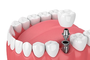 Diagram of a single tooth dental implant in Jupiter