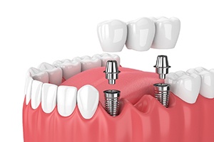Diagram of implant bridge for multiple missing teeth in Jupiter