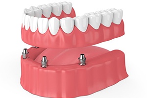 Diagram of implant dentures in Jupiter