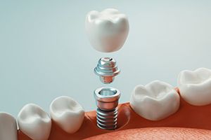 Diagram showing how dental implants in Jupiter work