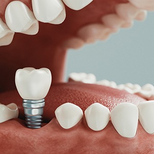 Diagram of a single tooth dental implant in Jupiter