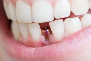 Closeup of patient’s teeth after dental implant surgery in Jupiter