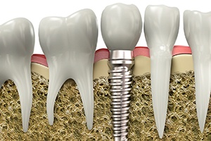 Diagram of dental implant in Jupiter after placement