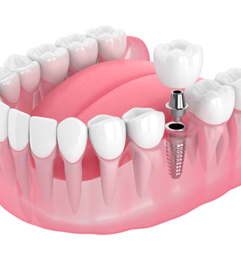 A diagram of a dental implant in Palm Beach Gardens.