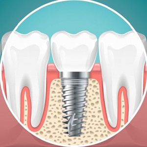 dental implant integrated with jawbone
