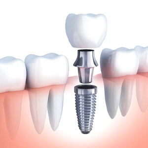 diagram of how dental implants work in Jupiter