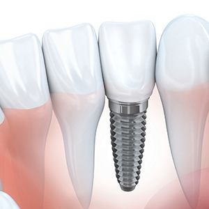 Animation of implant supported dental crown