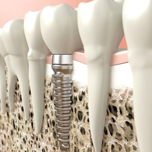 A diagram of an integrated dental implant.