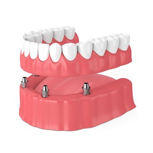 A diagram of a Teeth in a Day implant denture.