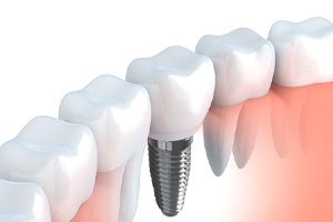 3D illustration of a dental implant and crown with part of the smile