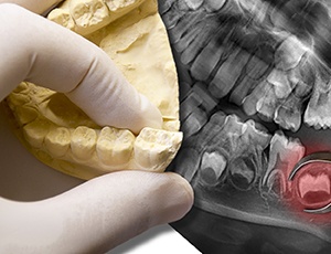 X-ray and model of wisdom tooth prior to extraction