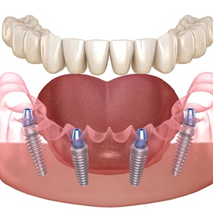 Illustration of Teeth in a Day in Royal Palm Beach