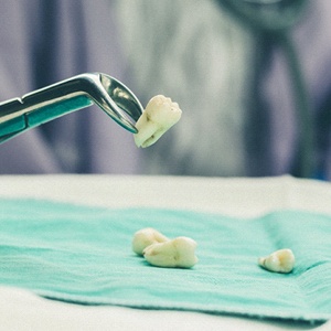 tooth extractions