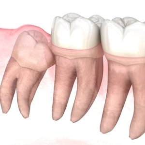 impacted wisdom tooth