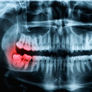 X-ray of a person with an impacted wisdom tooth.