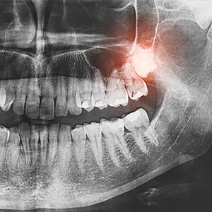 X-ray of impacted wisdom tooth
