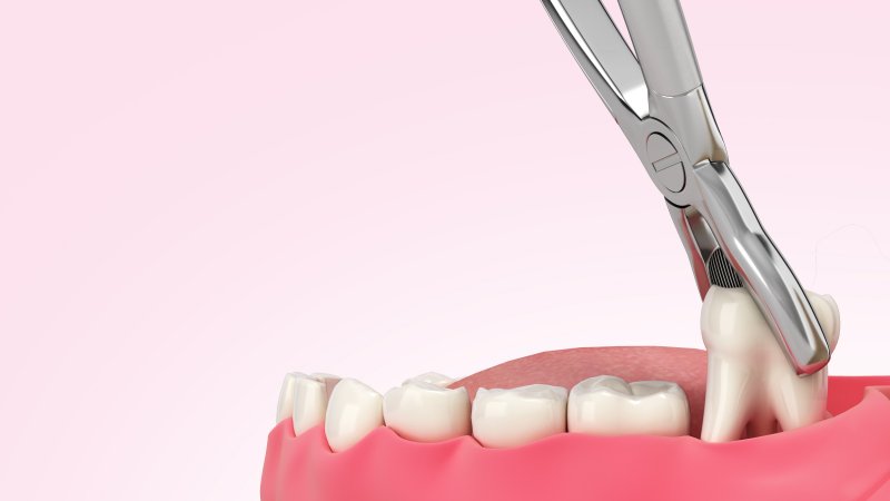 Diagram highlighting how tooth extraction works