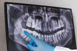 Dentist points to wisdom tooth in dental x-ray