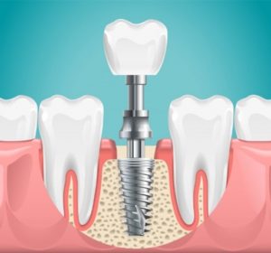 Illustration of a dental implant being used to replace a missing molar.