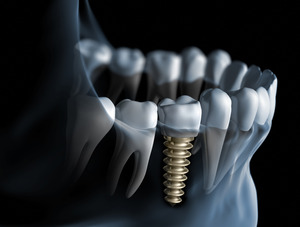 Illustration of a dental implant in the lower jaw