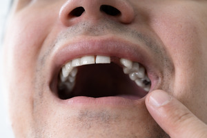 Close-up of a man with a missing tooth
