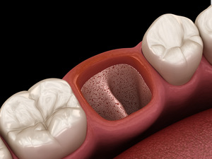 Illustration of a dry socket after oral surgery