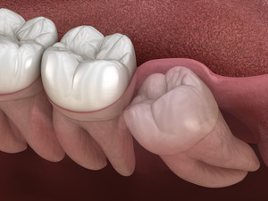 Render of an impacted wisdom tooth