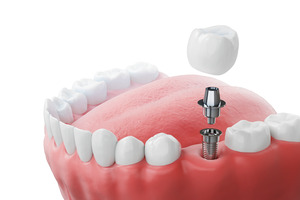 Render of parts of dental implant in lower arch