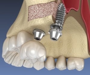 Dental implant posts in jawbone