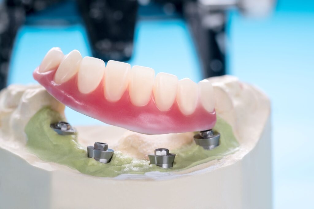 Lower arch of dentures resting on sample cast containing 4 dental implants