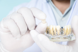 Oral surgeon holding the crown of a model dental implant